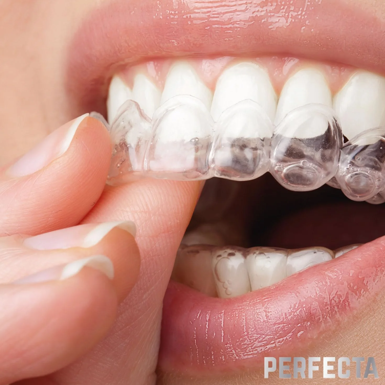 Férulas de Descarga Nocturna para Bruxismo, Rechinar los Dientes, Protectores Dentales Ajustables, Calidad Médica Sin BPA