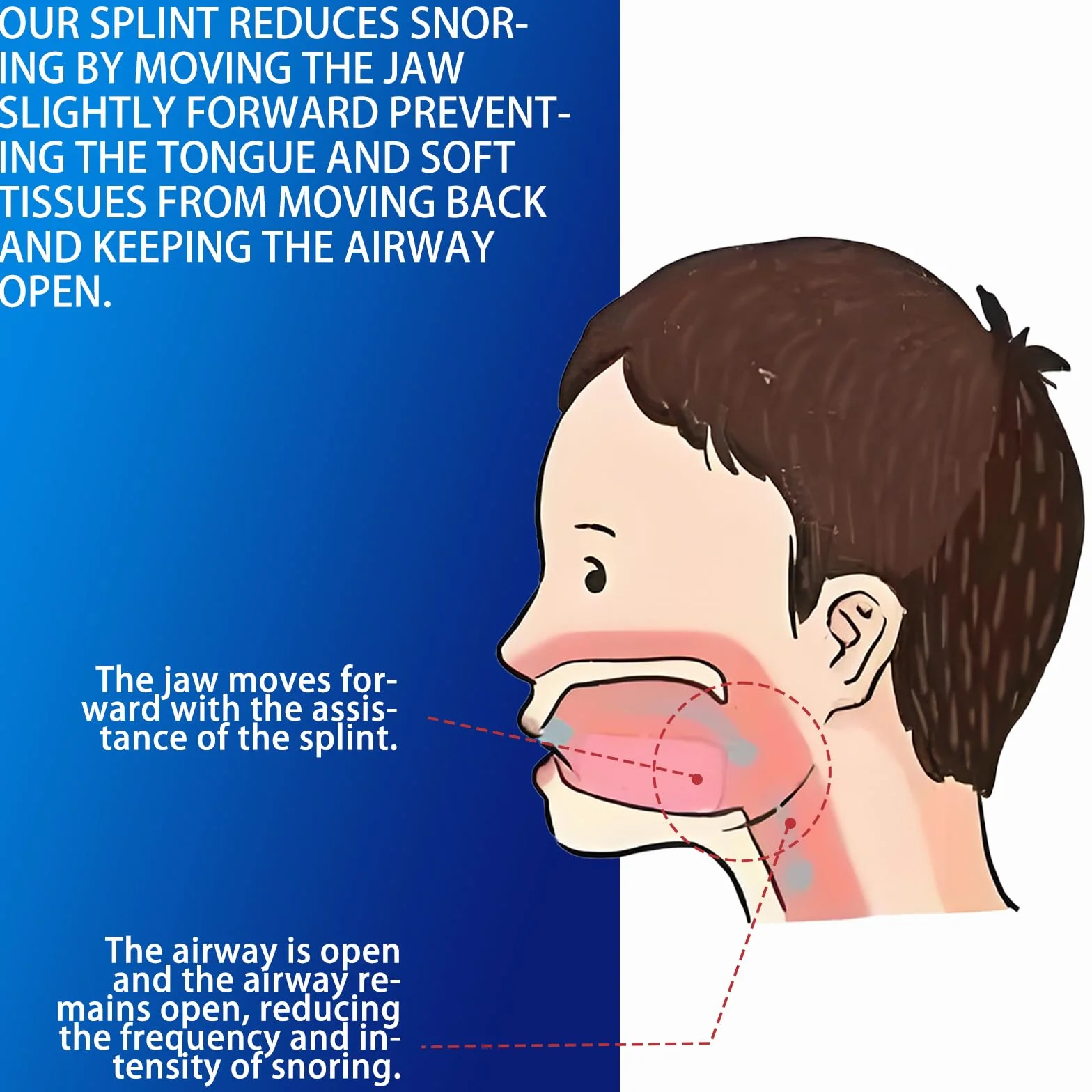 Férula Antirronquidos de Avance Mandibular, Dispositivo Ajustable Reutilizable Anti Ronquidos para Dormir